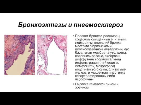 Бронхоэктазы и пневмосклероз Просвет бронхов расширен, содержит слущенный эпителий, лейкоциты, эпителий