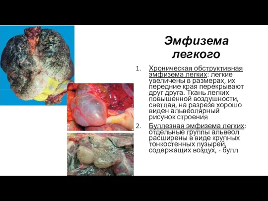 Эмфизема легкого Хроническая обструктивная эмфизема легких: легкие увеличены в размерах, их