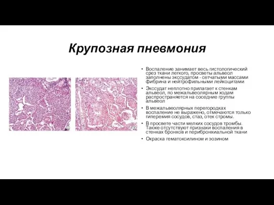 Крупозная пневмония Воспаление занимает весь гистологический срез ткани легкого, просветы альвеол