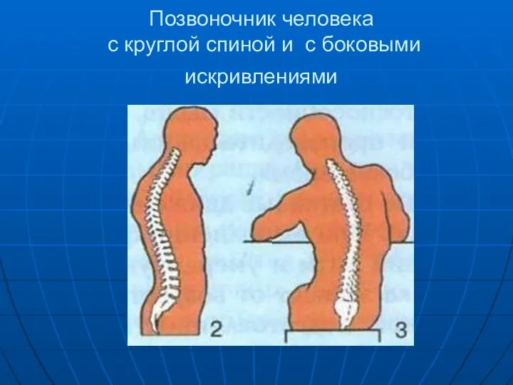 Позвоночник человека с круглой спиной и с боковыми искривлениями