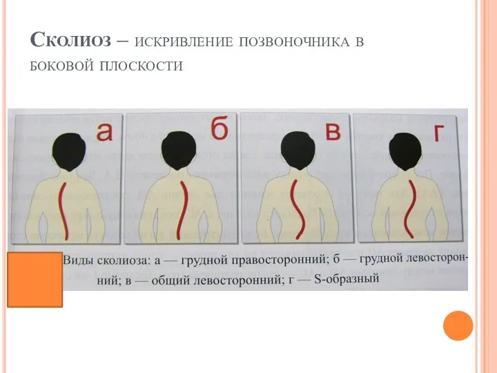 Сколиоз – искривление позвоночника в боковой плоскости