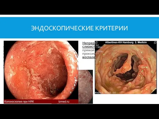 ЭНДОСКОПИЧЕСКИЕ КРИТЕРИИ Регионарное (прерывистое) поражение слизистой оболочки, симптом «булыжной мостовой» (сочетание