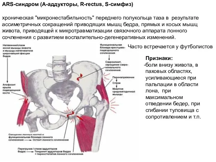 ARS-синдром (А-аддукторы, R-rectus, S-симфиз) хроническая "микронестабильность" переднего полукольца таза в результате