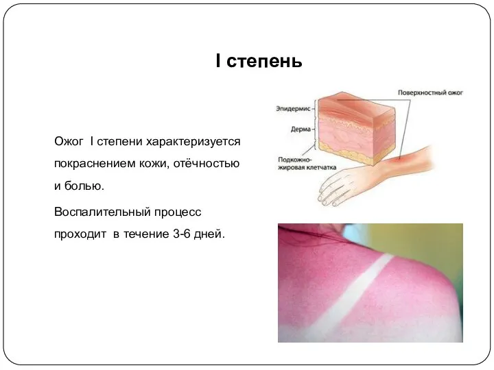 I степень Ожог I степени характеризуется покраснением кожи, отёчностью и болью.