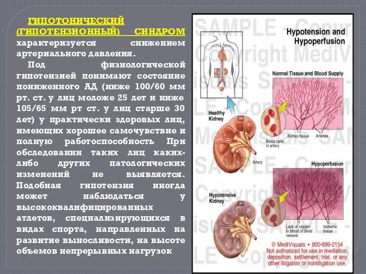 ГИПОТОНИЧЕСКИЙ (ГИПОТЕНЗИОННЫЙ) СИНДРОМ характеризуется снижением артериального давления. Под физиологической гипотензией понимают