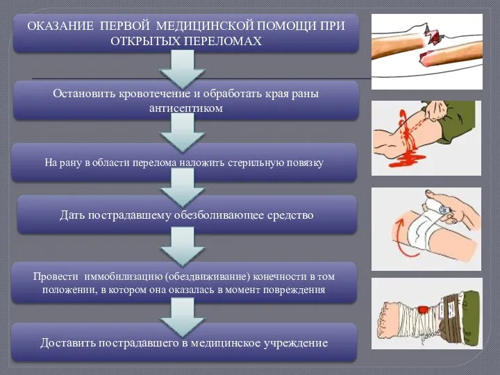 ОКАЗАНИЕ ПЕРВОЙ МЕДИЦИНСКОЙ ПОМОЩИ ПРИ ОТКРЫТЫХ ПЕРЕЛОМАХ Остановить кровотечение и обработать