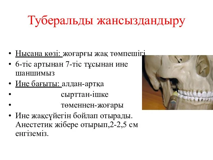 Нысана көзі: жоғарғы жақ төмпешігі 6-тіс артынан 7-тіс тұсынан ине шаншимыз