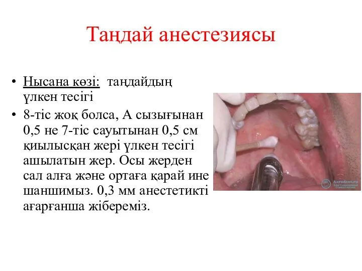 Таңдай анестезиясы Нысана көзі: таңдайдың үлкен тесігі 8-тіс жоқ болса, А