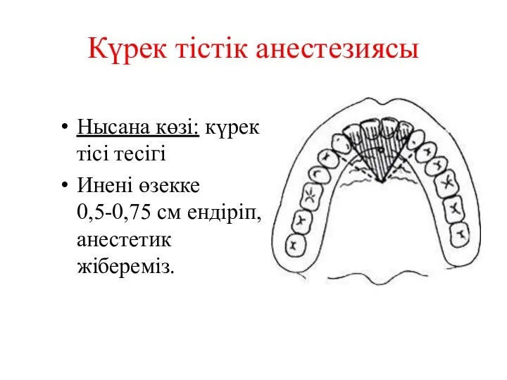 Күрек тістік анестезиясы Нысана көзі: күрек тісі тесігі Инені өзекке 0,5-0,75 см ендіріп, анестетик жібереміз.