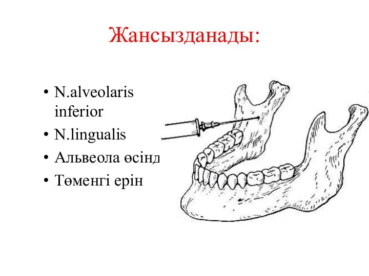 Жансызданады: N.alveolaris inferior N.lingualis Альвеола өсіндісі Төменгі ерін