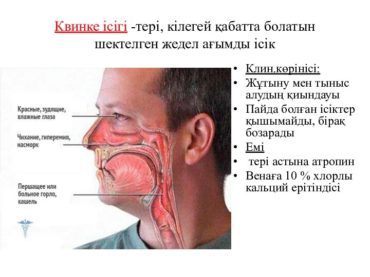 Квинке ісігі -тері, кілегей қабатта болатын шектелген жедел ағымды ісік Клин.көрінісі: