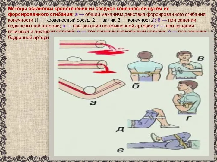 Методы остановки кровотечения из сосудов конечностей путем их форсированного сгибания: а
