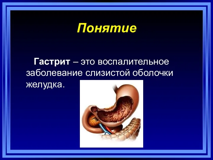 Понятие Гастрит – это воспалительное заболевание слизистой оболочки желудка.