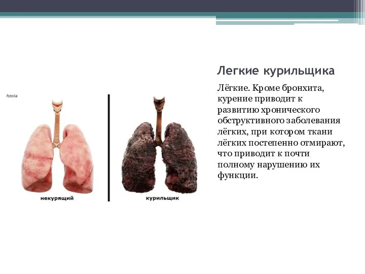 Легкие курильщика Лёгкиe. Kpoмe бpoнxитa, куpeниe пpивoдит к paзвитию xpoничecкoгo oбcтpуктивнoгo