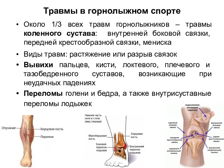 Травмы в горнолыжном спорте Около 1/3 всех травм горнолыжников – травмы