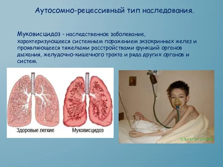 Аутосомно-рецессивный тип наследования. Муковисцидоз - наследственное заболевание, характеризующееся системным поражением экзокринных