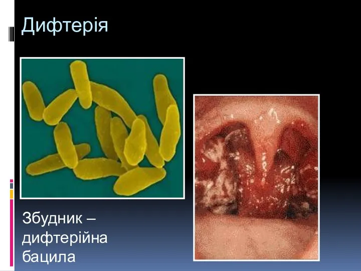 Дифтерія Збудник – дифтерійна бацила