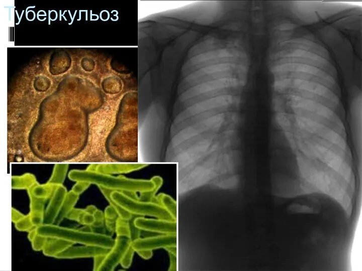 Туберкульоз Возбудитель- туберкулезная бацилла