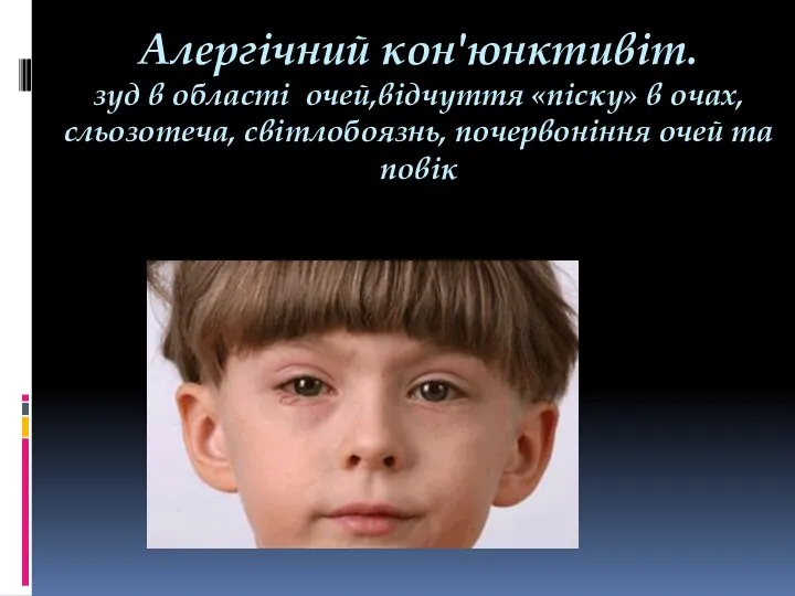 Алергічний кон'юнктивіт. зуд в області очей,відчуття «піску» в очах, сльозотеча, світлобоязнь, почервоніння очей та повік