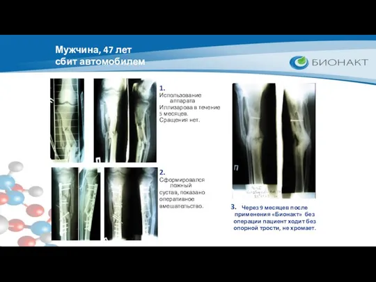Мужчина, 47 лет сбит автомобилем Использование аппарата Иллизарова в течение 5