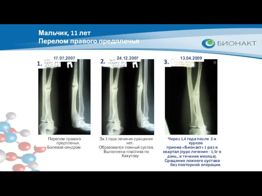 Мальчик, 11 лет Перелом правого предплечья 1. 2. 3. Перелом правого