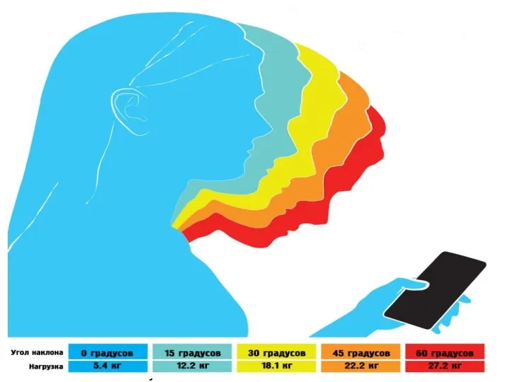 Синдром Text neck Нагрузка на шейный отдел позвоночника значительно возрастает, если