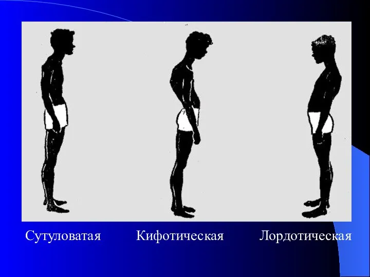 Сутуловатая Кифотическая Лордотическая