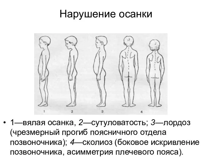 Нарушение осанки 1—вялая осанка, 2—сутуловатость; 3—лордоз (чрезмерный прогиб пояснич­ного отдела позвоночника);