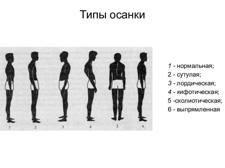 Типы осанки 1 - нормальная; 2 - сутулая; 3 - лордическая;