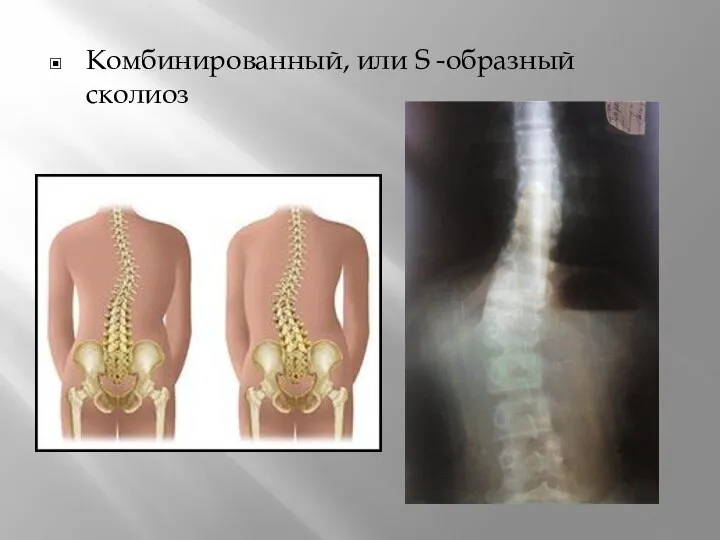 Комбинированный, или S -образный сколиоз