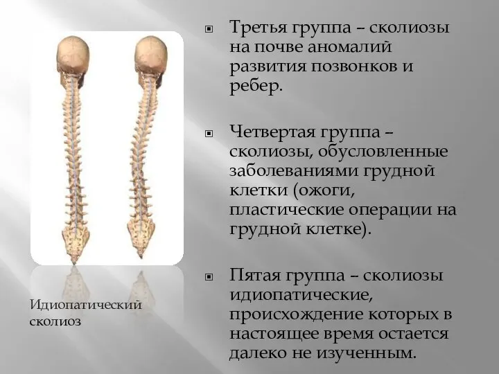 Идиопатический сколиоз Третья группа – сколиозы на почве аномалий развития позвонков