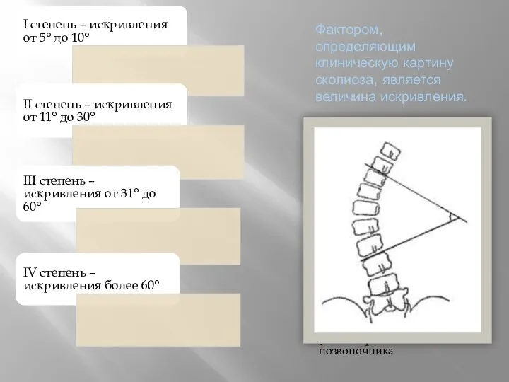 Фактором, определяющим клиническую картину сколиоза, является величина искривления. Угол искривления позвоночника