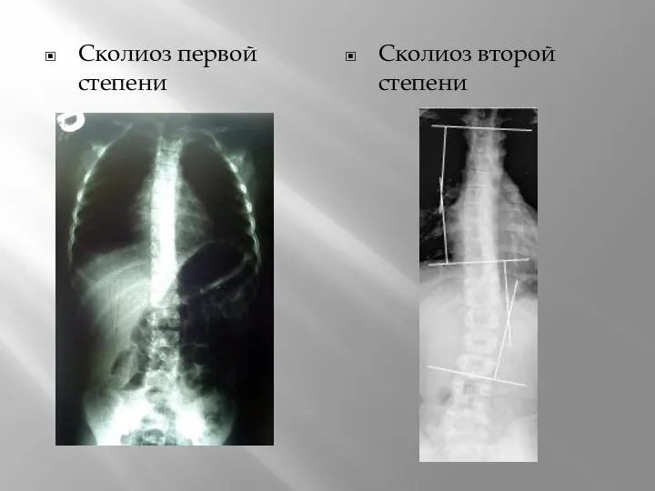 Сколиоз первой степени Сколиоз второй степени