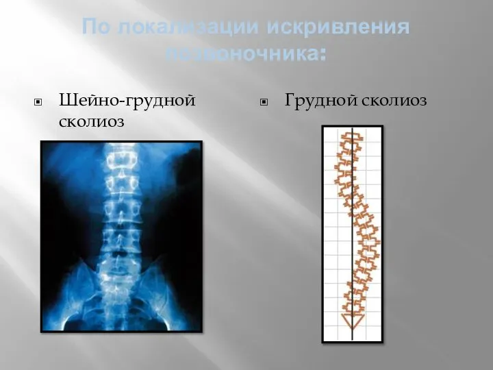 По локализации искривления позвоночника: Шейно-грудной сколиоз Грудной сколиоз