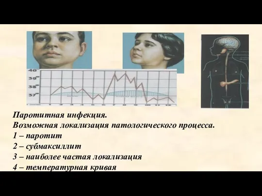 Паротитная инфекция. Возможная локализация патологического процесса. 1 – паротит 2 –