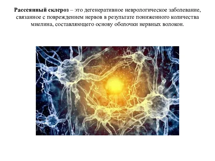 Рассеянный склероз – это дегенеративное неврологическое заболевание, связанное с повреждением нервов