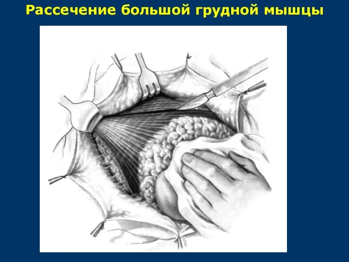 Рассечение большой грудной мышцы