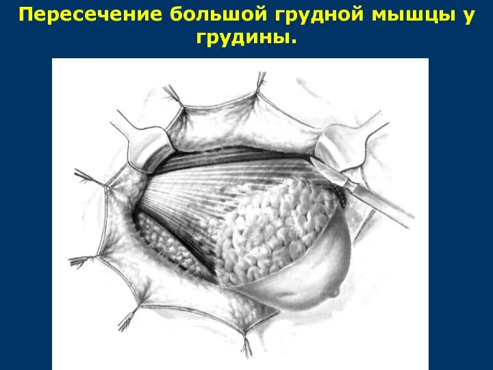 Пересечение большой грудной мышцы у грудины.