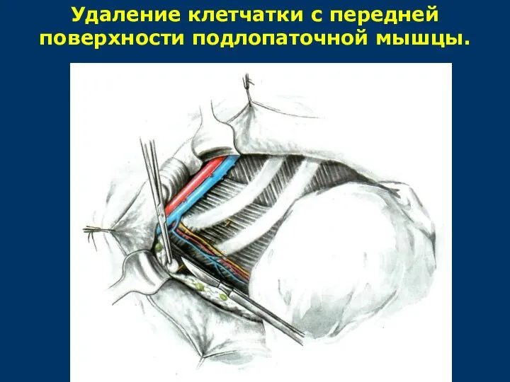 Удаление клетчатки с передней поверхности подлопаточной мышцы.