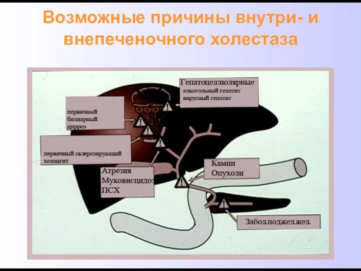 Возможные причины внутри- и внепеченочного холестаза