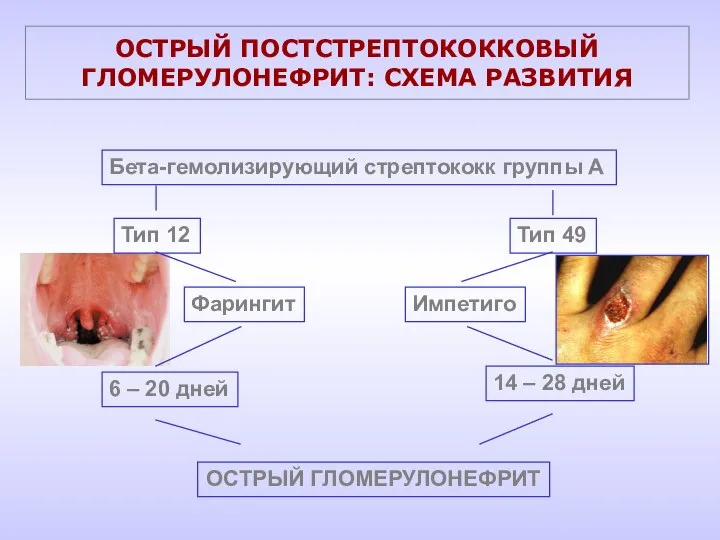 ОСТРЫЙ ПОСТСТРЕПТОКОККОВЫЙ ГЛОМЕРУЛОНЕФРИТ: СХЕМА РАЗВИТИЯ Бета-гемолизирующий стрептококк группы А Тип 12