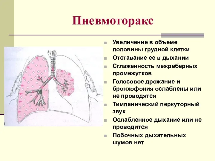 Пневмоторакс Увеличение в объеме половины грудной клетки Отставание ее в дыхании