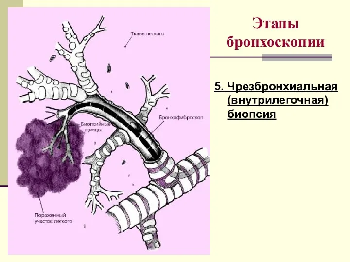 Этапы бронхоскопии 5. Чрезбронхиальная (внутрилегочная) биопсия