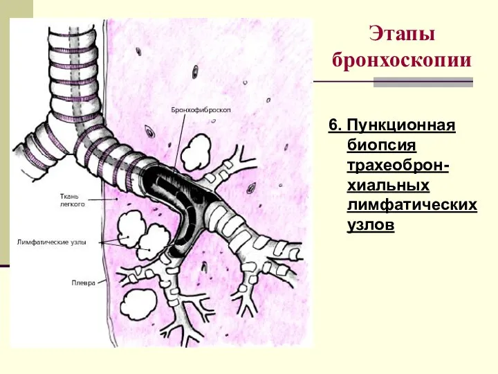 Этапы бронхоскопии 6. Пункционная биопсия трахеоброн-хиальных лимфатических узлов