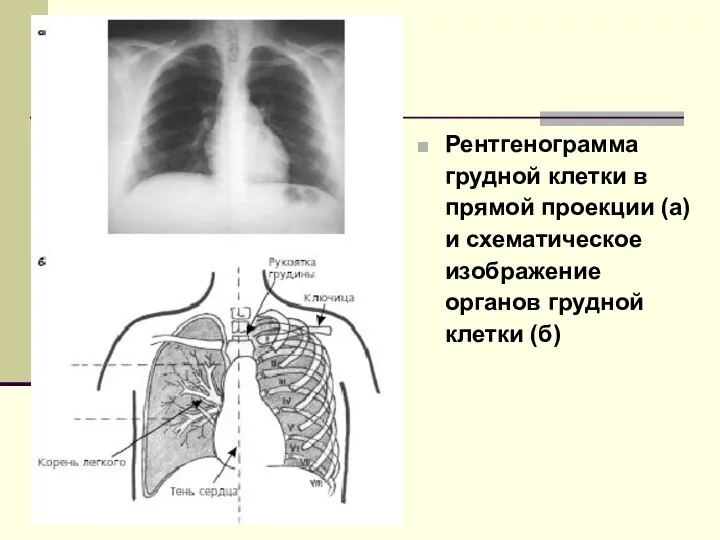 Рентгенограмма грудной клетки в прямой проекции (а) и схематическое изображение органов грудной клетки (б)
