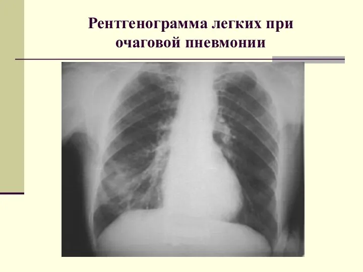 Рентгенограмма легких при очаговой пневмонии