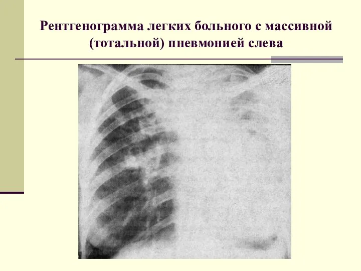 Рентгенограмма легких больного с массивной (тотальной) пневмонией слева