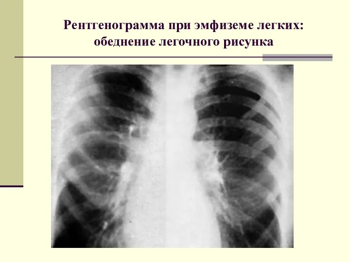 Рентгенограмма при эмфиземе легких: обеднение легочного рисунка