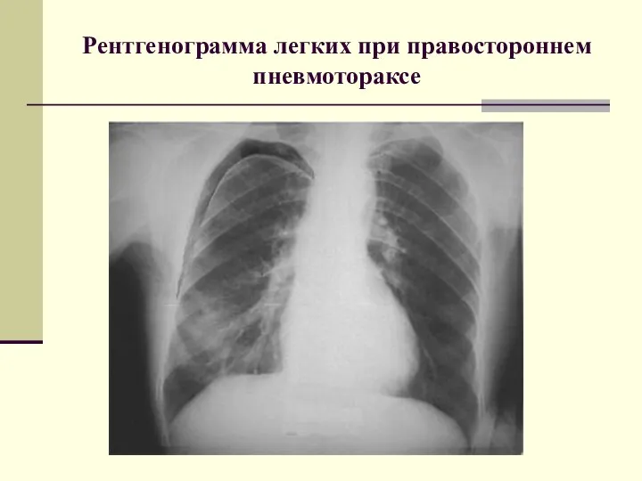 Рентгенограмма легких при правостороннем пневмотораксе