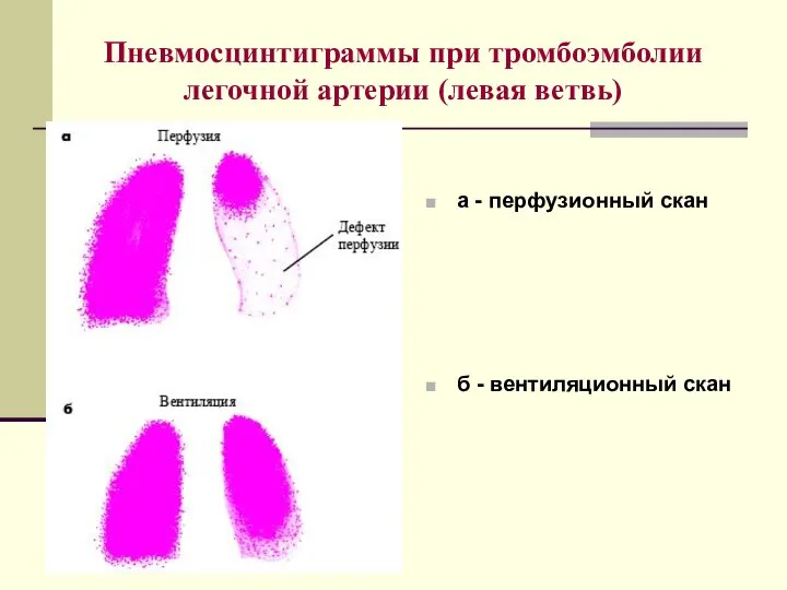Пневмосцинтиграммы при тромбоэмболии легочной артерии (левая ветвь) а - перфузионный скан б - вентиляционный скан